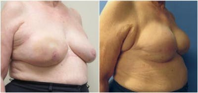 Breast Reconstruction Before & After Gallery - Patient 394190 - Image 2