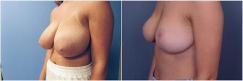 Breast Reduction Before & After Gallery - Patient 393378 - Image 3