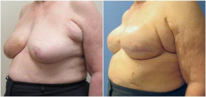 Breast Reconstruction Before & After Gallery - Patient 394190 - Image 3