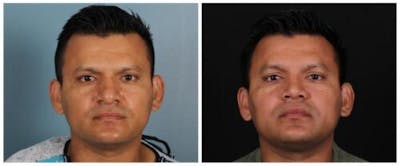 Rhinoplasty Before & After Gallery - Patient 239849 - Image 1