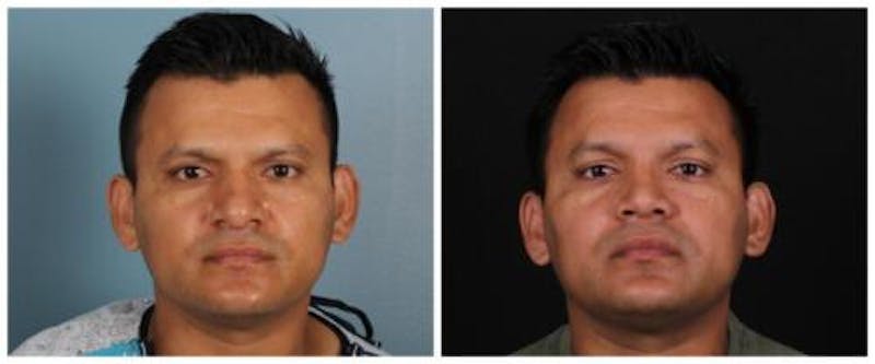 Rhinoplasty Before & After Gallery - Patient 239849 - Image 1