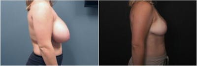 Breast Reduction Before & After Gallery - Patient 393359 - Image 1