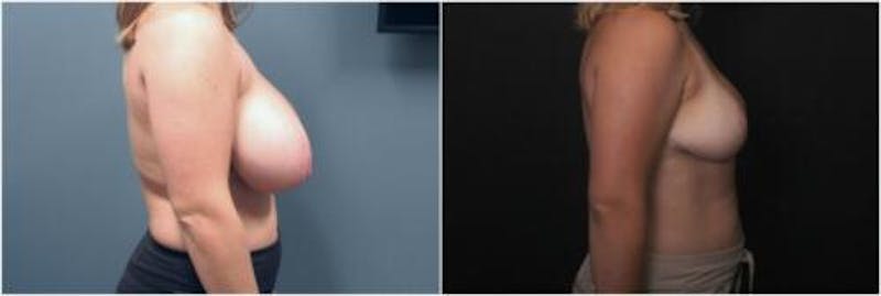Breast Reduction Before & After Gallery - Patient 393359 - Image 1