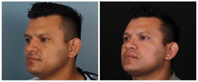Rhinoplasty Before & After Gallery - Patient 239849 - Image 2