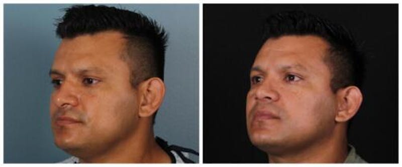 Rhinoplasty Before & After Gallery - Patient 239849 - Image 2