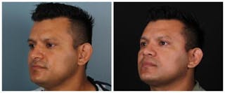 Rhinoplasty Before & After Gallery - Patient 239849 - Image 2