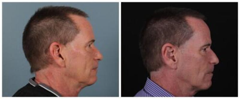 Otoplasty Before & After Gallery - Patient 840455 - Image 4