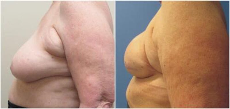 Breast Reconstruction Before & After Gallery - Patient 394190 - Image 4