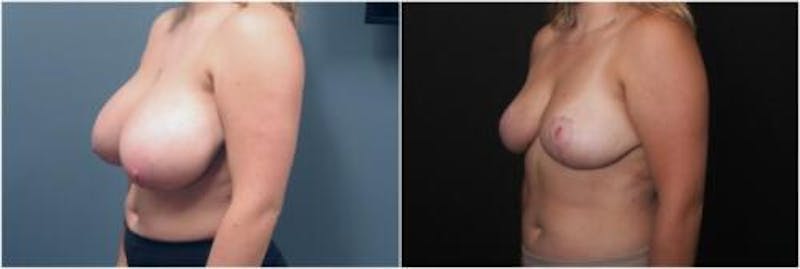 Breast Reduction Before & After Gallery - Patient 393359 - Image 2