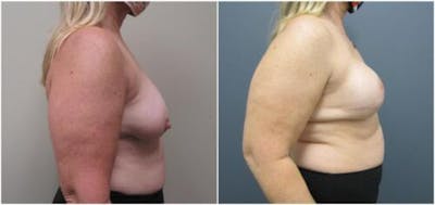 Breast Reconstruction Before & After Gallery - Patient 402015 - Image 1