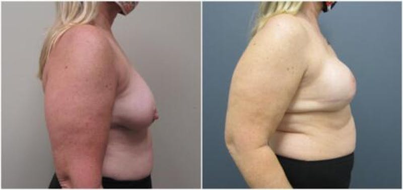 Breast Reconstruction Before & After Gallery - Patient 402015 - Image 1