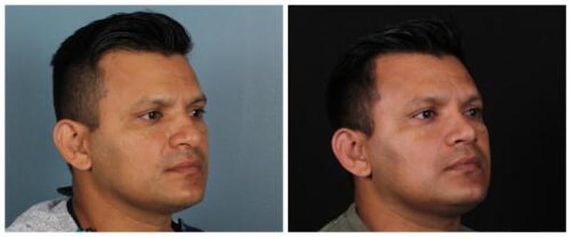 Rhinoplasty Before & After Gallery - Patient 239849 - Image 3