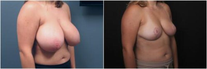 Breast Reduction Before & After Gallery - Patient 393359 - Image 3
