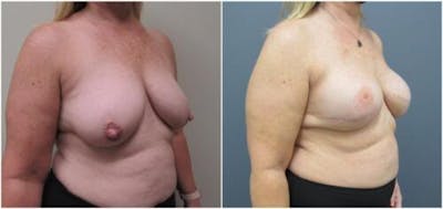 Breast Reconstruction Before & After Gallery - Patient 402015 - Image 2