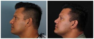 Rhinoplasty Before & After Gallery - Patient 239849 - Image 4