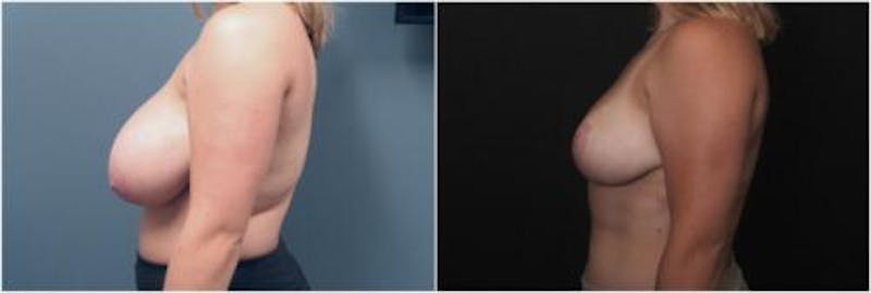 Breast Reduction Before & After Gallery - Patient 393359 - Image 4