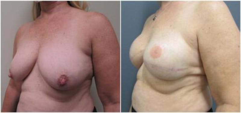 Breast Reconstruction Before & After Gallery - Patient 402015 - Image 3