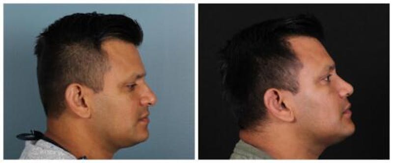Rhinoplasty Before & After Gallery - Patient 239849 - Image 5