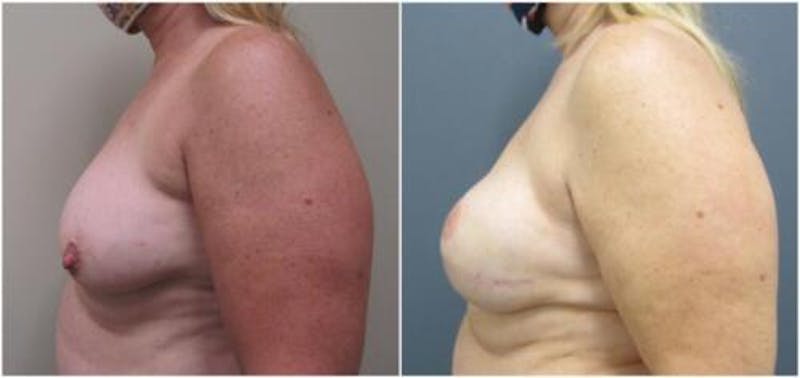 Breast Reconstruction Before & After Gallery - Patient 402015 - Image 4