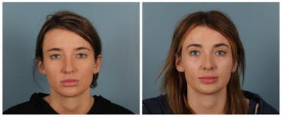 Rhinoplasty Before & After Gallery - Patient 125883 - Image 1