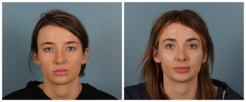 Rhinoplasty Before & After Gallery - Patient 125883 - Image 1