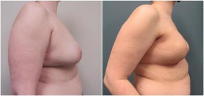 Breast Reconstruction Before & After Gallery - Patient 173650 - Image 1