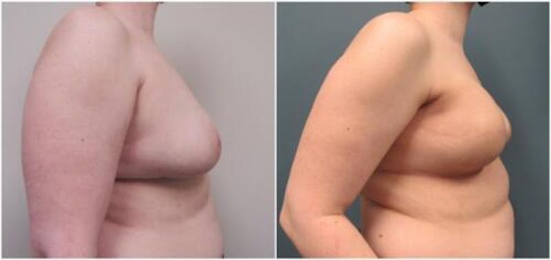 Breast Reconstruction Before & After Gallery - Patient 173650 - Image 1