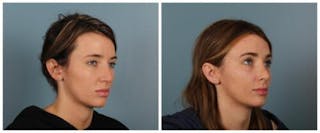 Rhinoplasty Before & After Gallery - Patient 125883 - Image 2