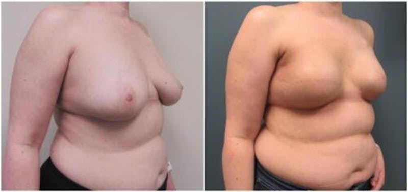 Breast Reconstruction Before & After Gallery - Patient 173650 - Image 2