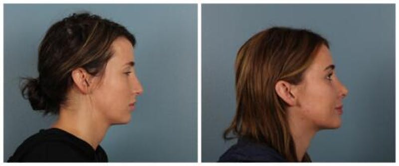 Rhinoplasty Before & After Gallery - Patient 125883 - Image 3
