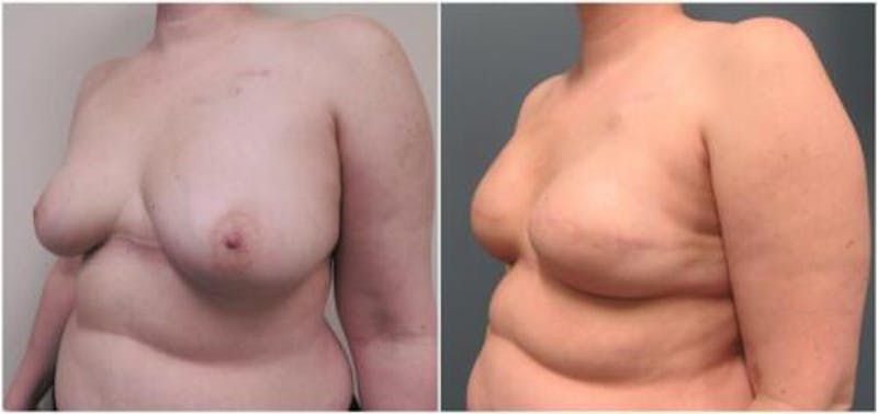 Breast Reconstruction Before & After Gallery - Patient 173650 - Image 3