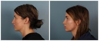 Rhinoplasty Before & After Gallery - Patient 125883 - Image 4