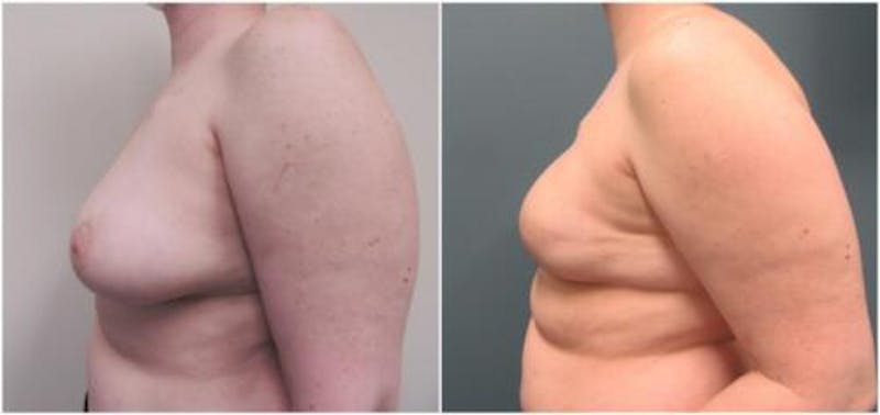 Breast Reconstruction Before & After Gallery - Patient 173650 - Image 4