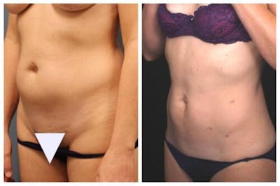 Liposuction Before & After Gallery - Patient 376483 - Image 1