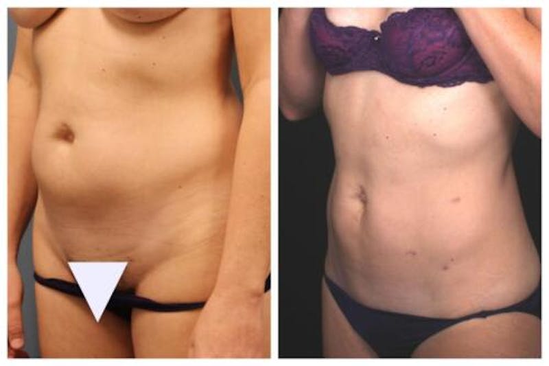 Liposuction Before & After Gallery - Patient 376483 - Image 1