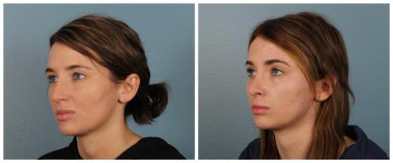 Rhinoplasty Before & After Gallery - Patient 125883 - Image 5