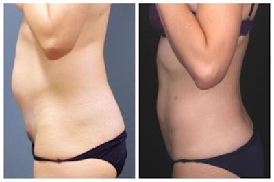 Liposuction Before & After Gallery - Patient 376483 - Image 2