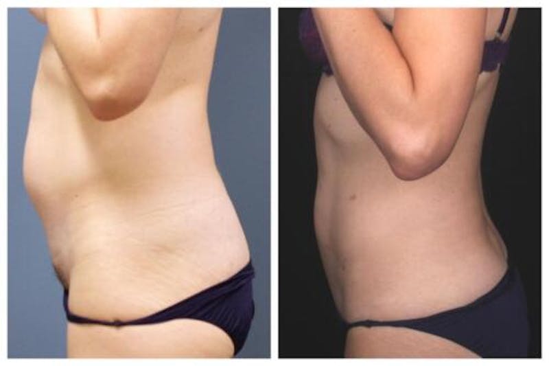 Liposuction Before & After Gallery - Patient 376483 - Image 2