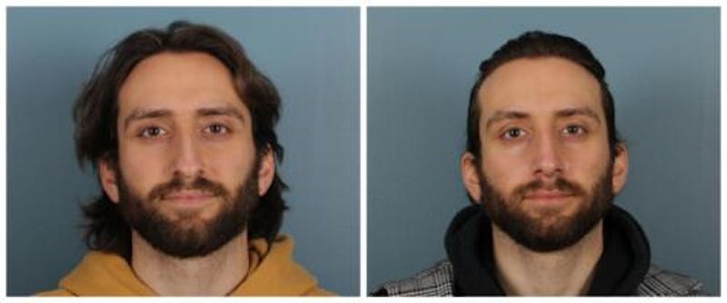 Rhinoplasty Before & After Gallery - Patient 352634 - Image 1