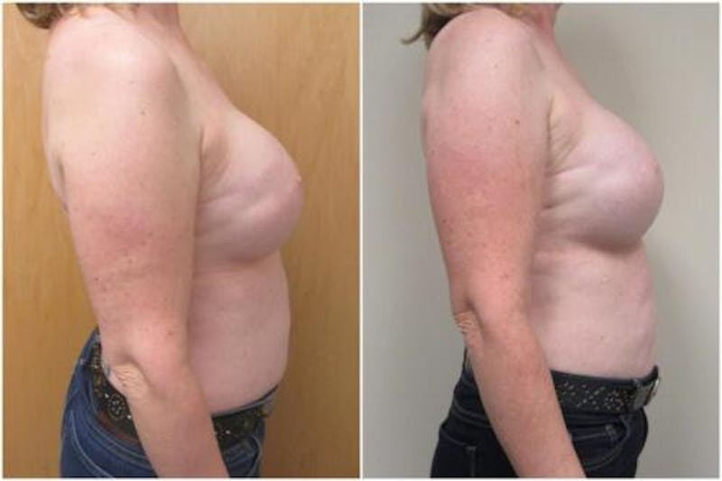 Breast Reconstruction Before & After Gallery - Patient 206708 - Image 1