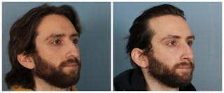 Rhinoplasty Before & After Gallery - Patient 352634 - Image 2