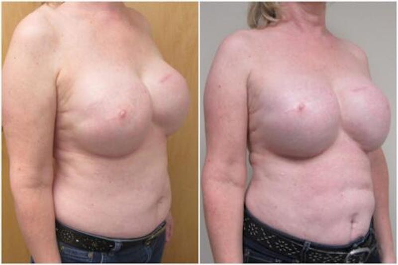 Breast Reconstruction Before & After Gallery - Patient 206708 - Image 2