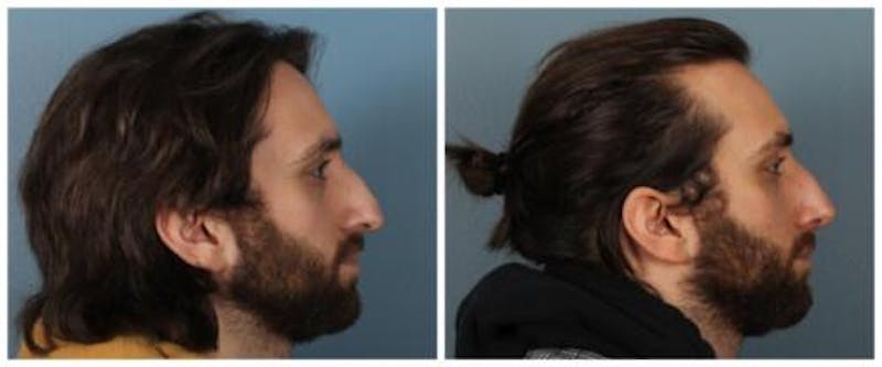 Rhinoplasty Before & After Gallery - Patient 352634 - Image 3