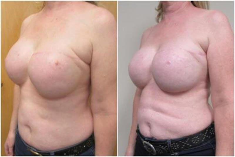 Breast Reconstruction Before & After Gallery - Patient 206708 - Image 3