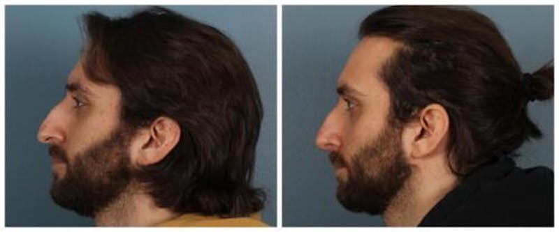 Rhinoplasty Before & After Gallery - Patient 352634 - Image 4
