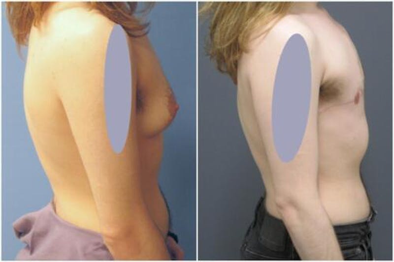 FTM Mastectomy Before & After Gallery - Patient 340792 - Image 1