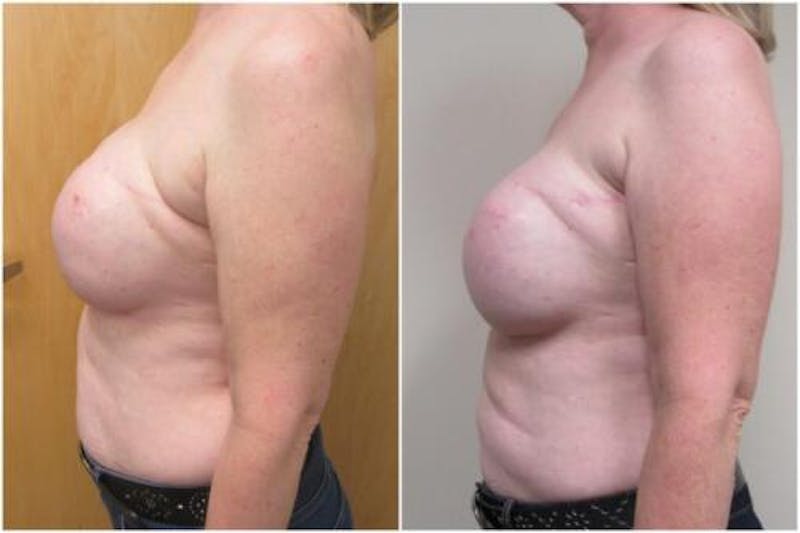 Breast Reconstruction Before & After Gallery - Patient 206708 - Image 4