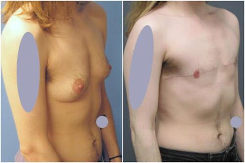 FTM Mastectomy Before & After Gallery - Patient 340792 - Image 2