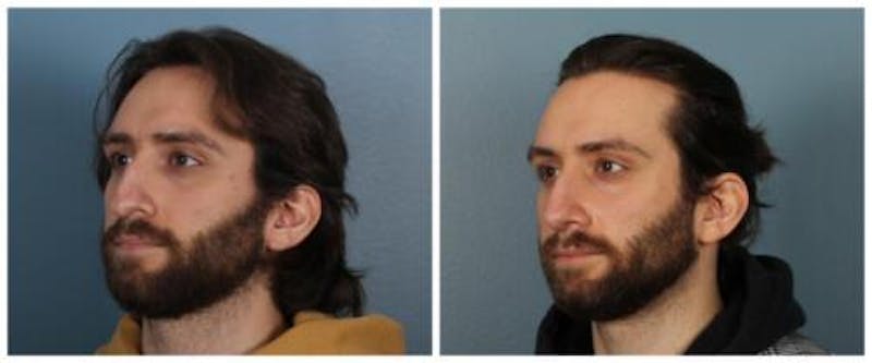 Rhinoplasty Before & After Gallery - Patient 352634 - Image 5