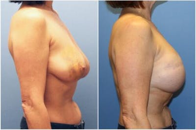 Breast Reconstruction Before & After Gallery - Patient 105769 - Image 1